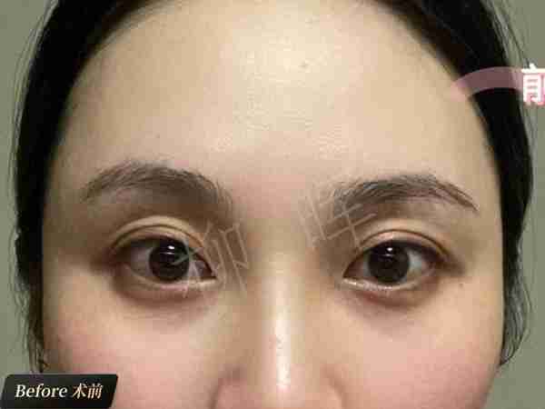 眼窝凹陷面露凶相?打了玻尿酸,眼睛好看,亲和力满满!