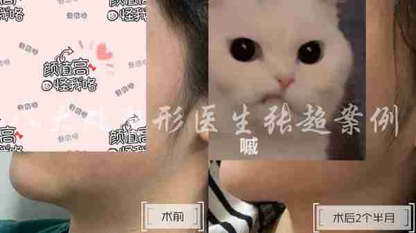 八大处张超面部吸脂反馈合集(五)