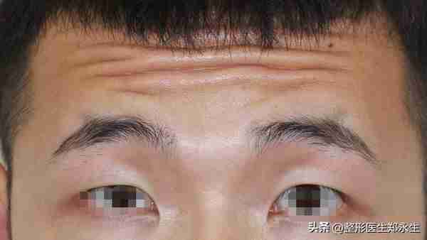 同样是割双眼皮,为什么有的人年轻了10岁,而有的人老了10岁?
