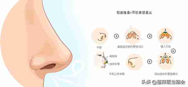 为什么用硅胶+耳软骨隆鼻,容易“透光+下旋”?(隆鼻必看)