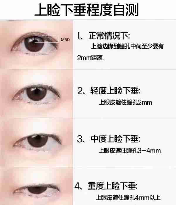 做双眼皮要花多少钱?怎么判断要不要开眼角?有哪些注意事项?