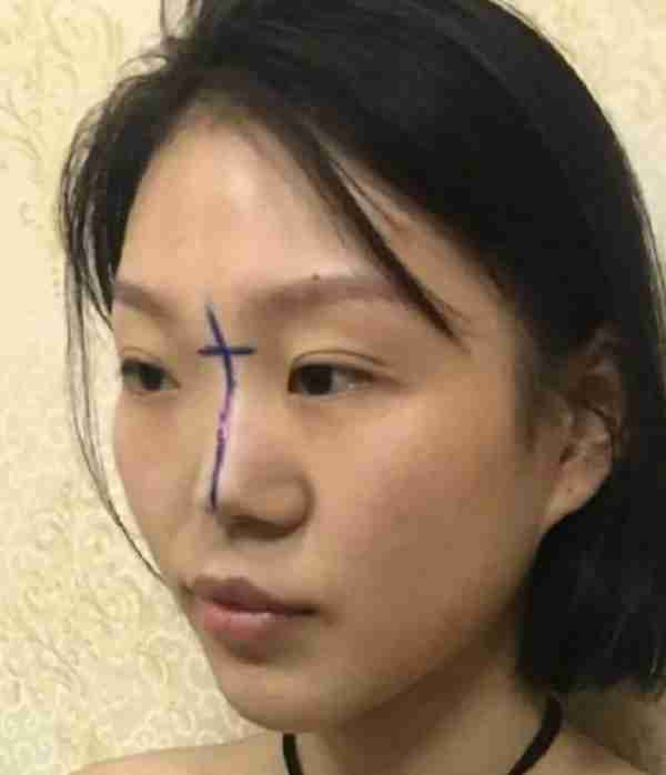 想要做成高级脸,鼻综合:肋软骨隆鼻