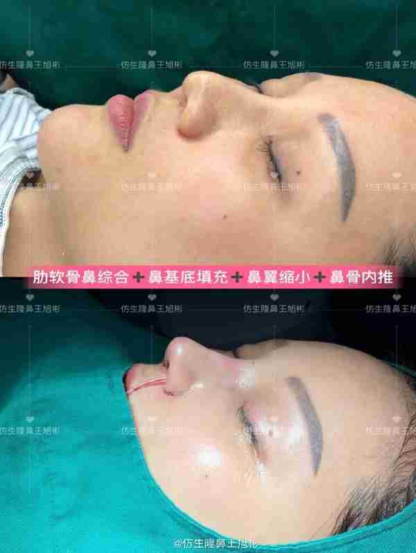 初鼻当心:硅胶假体隆鼻后,什么原因会造成包膜挛缩?可防可治吗