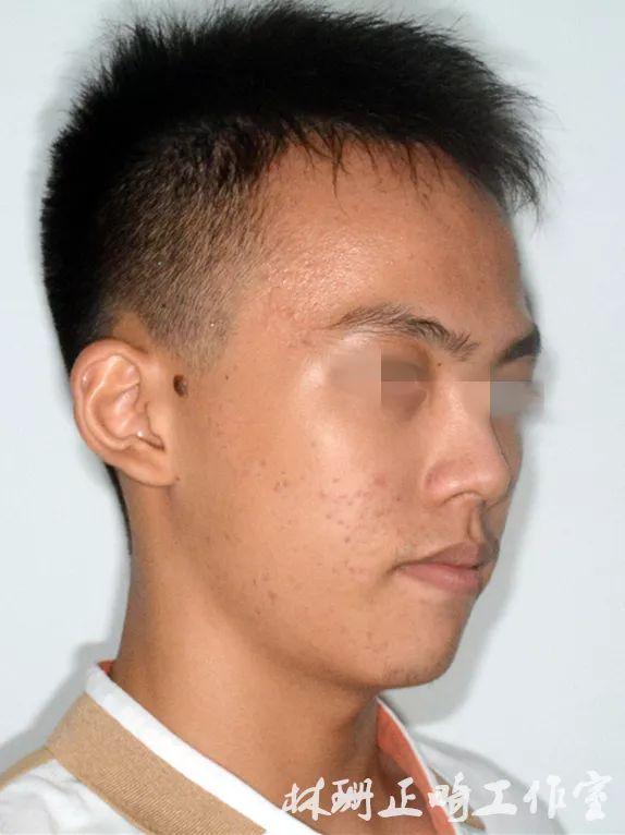 福州牙齿矫正 | 前突龅牙患者害怕骨钉,改用z钩获得很好的内收效果