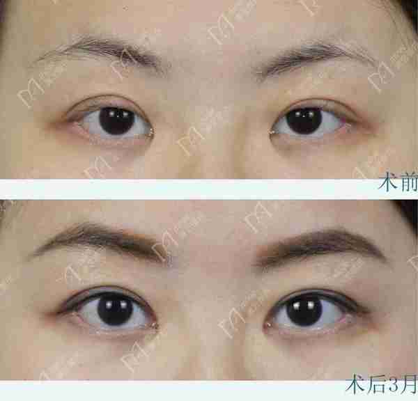 双眼皮术后出现肉条不要急着做双眼皮修复,要先分析原因。