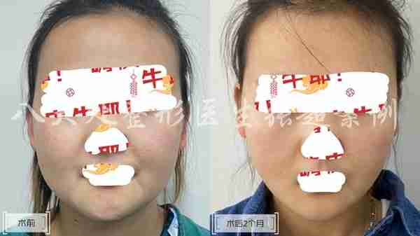 八大处张超面部吸脂反馈合集(五)