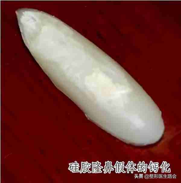 硅胶隆鼻是永久的吗?用它做鼻子有什么危害吗?