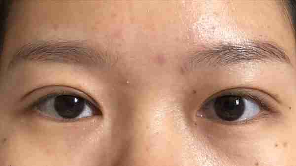 做个双眼皮要花1.5w元钱?为什么别人几百块就行?医生告诉您