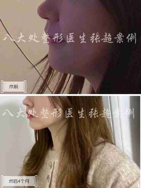 八大处张超面部吸脂反馈合集(五)