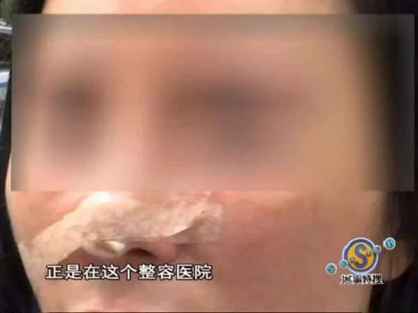 女子花9万元整容结果鼻子歪了 院方人员:去跳楼啊