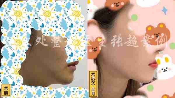 八大处张超面部吸脂反馈合集(五)