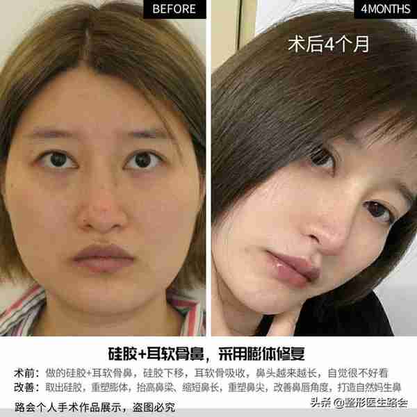 山西求美者:后悔死了!耳软骨垫鼻尖3年了,一直发红,怎么办?
