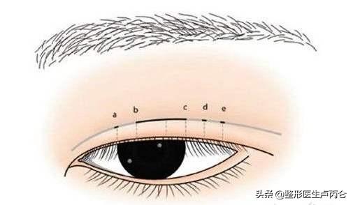 韩式三点微创双眼皮有哪些优点?比起欧式双眼皮如何?