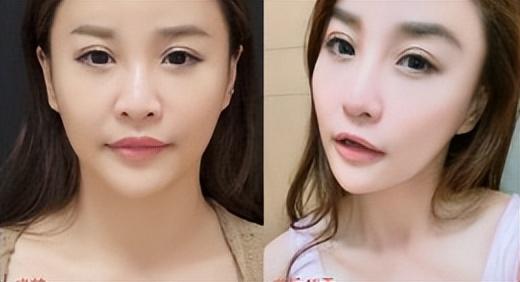 姑娘来太原丽都医院隆鼻整形,术后半年“惊艳”所有人!