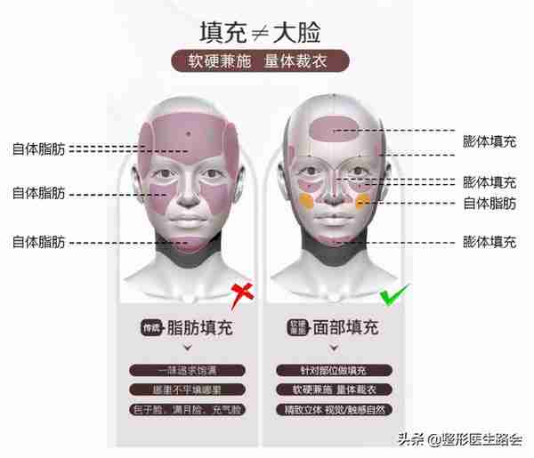 关于自体脂肪填充,那些整形医生不会告诉你的