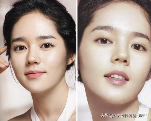 面部一枝花,全靠鼻当家,“一支玻尿酸”解救娱乐圈无数塌鼻梁