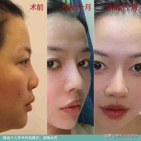 做完膨体鼻最害怕的事:感染与取出!整形医生谈膨体隆鼻的后遗症