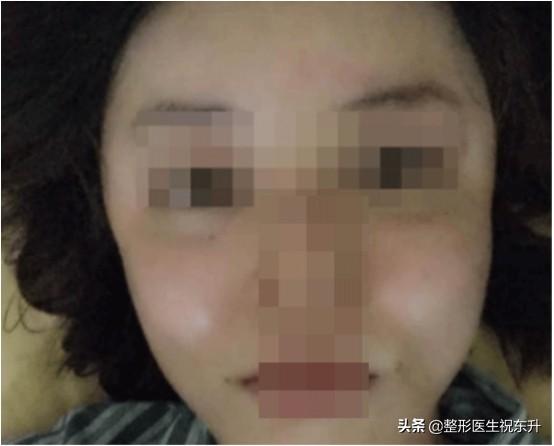 填充点脂肪,会导致脸下垂?脂肪表示不背这个"锅"
