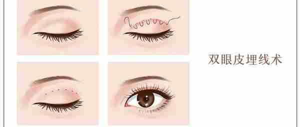 春节假期来临,双眼皮手术了解一下?