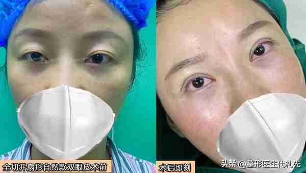 40岁后上眼睑松弛下垂了，提眉好还是全切双眼皮好？