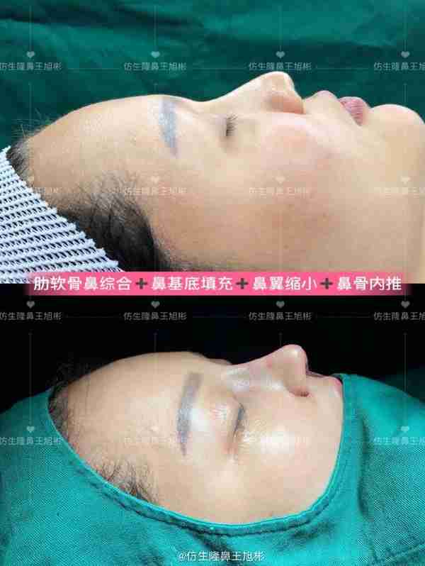 初鼻当心:硅胶假体隆鼻后,什么原因会造成包膜挛缩?可防可治吗