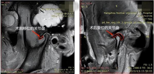 突然张不开嘴,连饭都吃不了!这个面部高发疾病要警惕