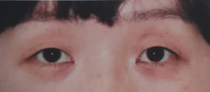 想割双眼皮,到底要不要开眼角?