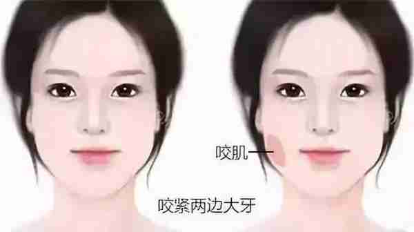 瘦脸针怎么打?