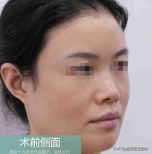 30岁+女士赴京整形,膨体隆鼻+鼻基底填充全记录,5个月后大变样