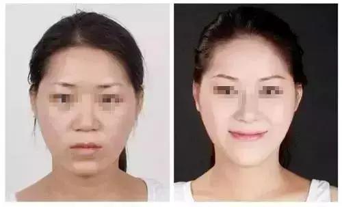你适合打瘦脸针吗?