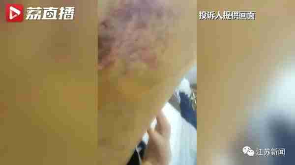 花6万元吸脂后皮肤坏死,双腿凹凸不平!还没修复好,整形医院去哪了?