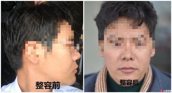 男子花1.2万隆鼻后竟能晃动,美容院:这是正常误差范围
