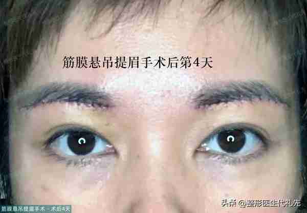 49岁眼皮松弛做提眉还是全切双眼皮?女士选择提眉手术,术后13天