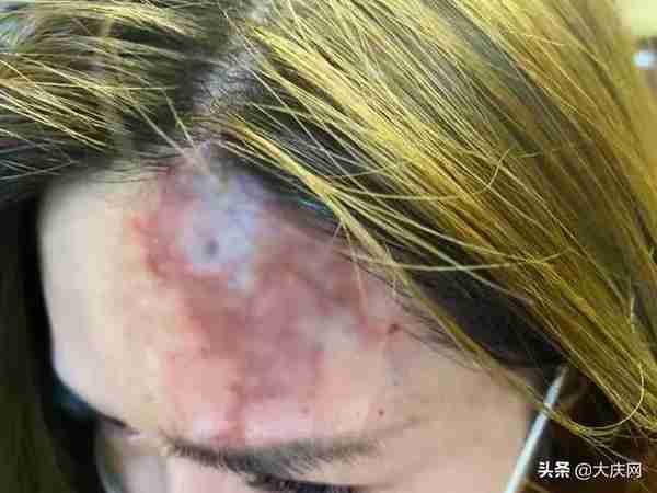 花4万块丰额头,两针打下去差点毁容