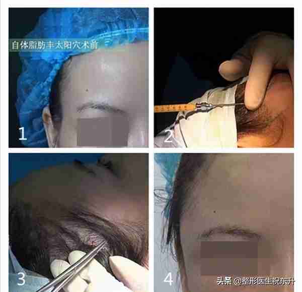 被大家“吹上天”的自体脂肪填充,真的有那么好吗?