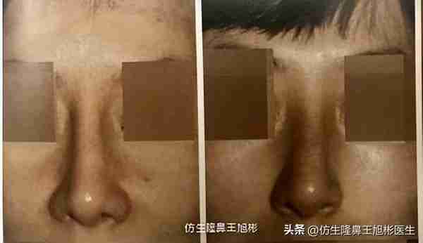 初鼻当心:硅胶假体隆鼻后,什么原因会造成包膜挛缩?可防可治吗