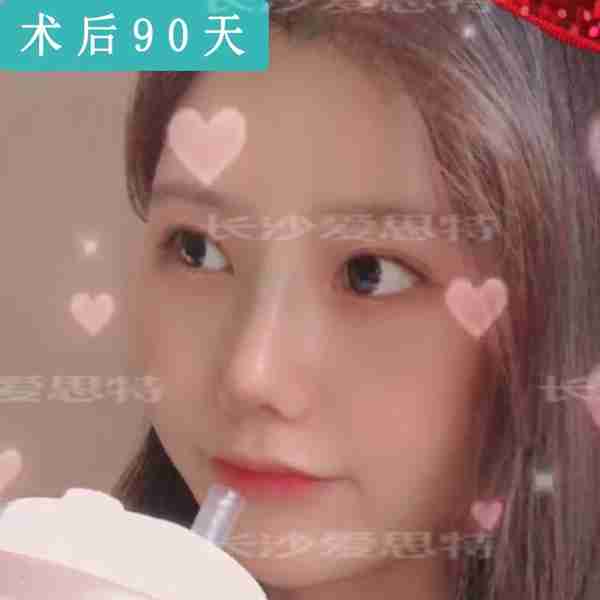 现在耳软骨隆鼻多少钱?恢复需要多长时间?可以维持多久?