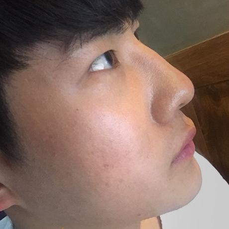 硅胶+鼻中隔+耳软骨男士隆鼻案例分享