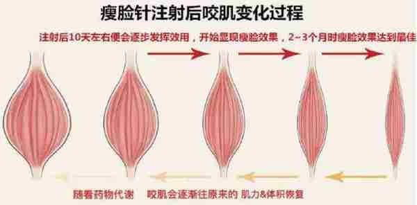 科普篇|「瘦脸针」原理,能否定型,会有哪些副作用...