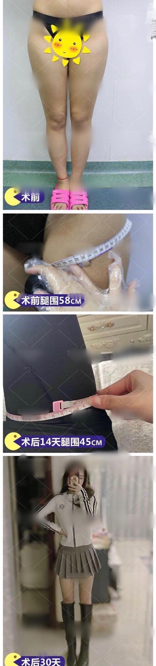 成都吸脂整形医院测评