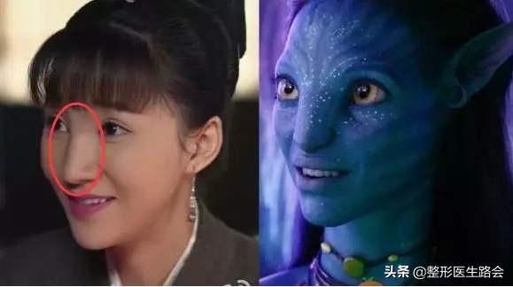 玻尿酸注射隆鼻,你后悔了吗?