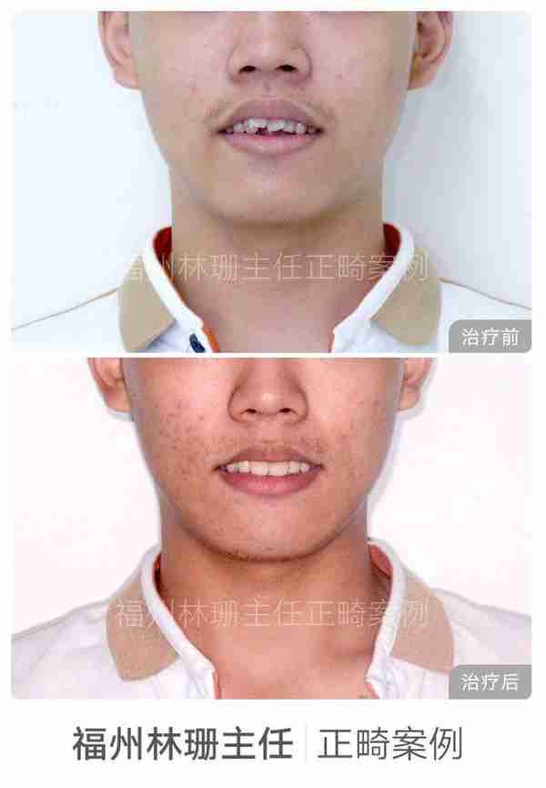 福州牙齿矫正 | 前突龅牙患者害怕骨钉,改用z钩获得很好的内收效果