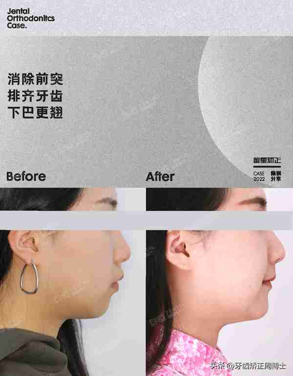 缺牙先别急着种!高性价比矫正案例,一次省去2颗种植费用