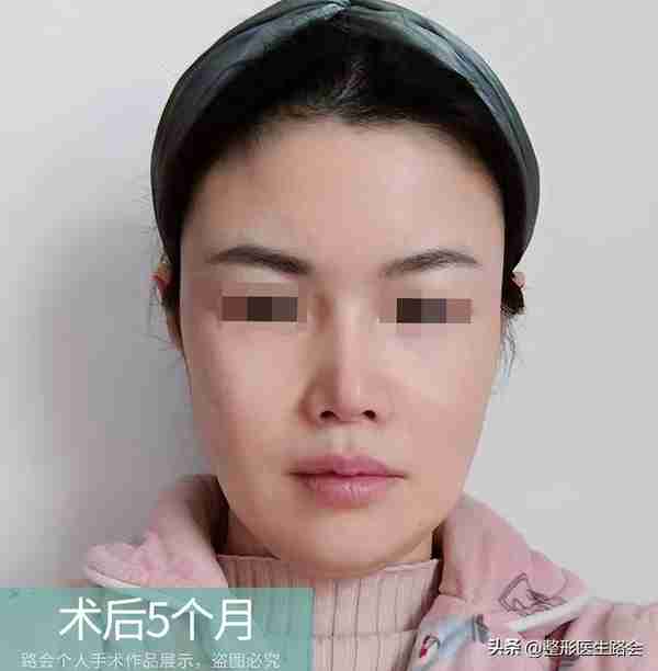 30岁+女士赴京整形,膨体隆鼻+鼻基底填充全记录,5个月后大变样