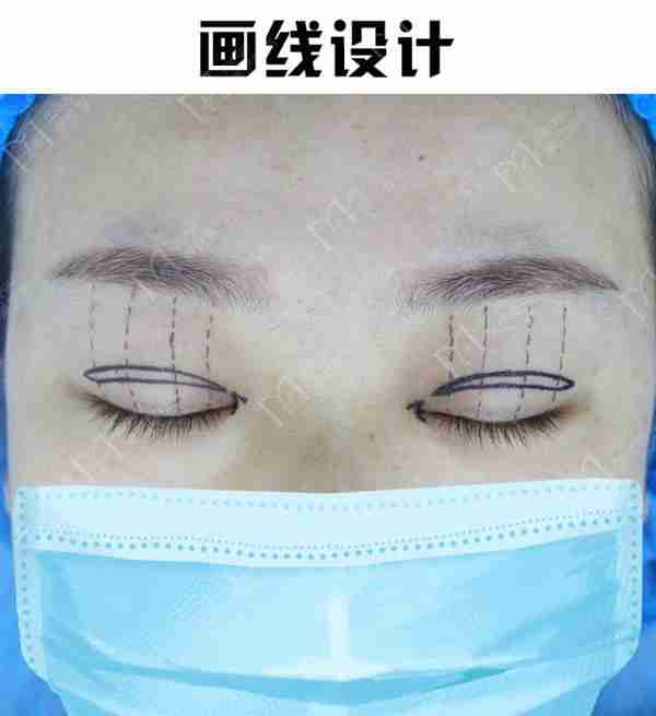 双眼皮想要内双变外双,不是说通过双眼皮就可以改善的