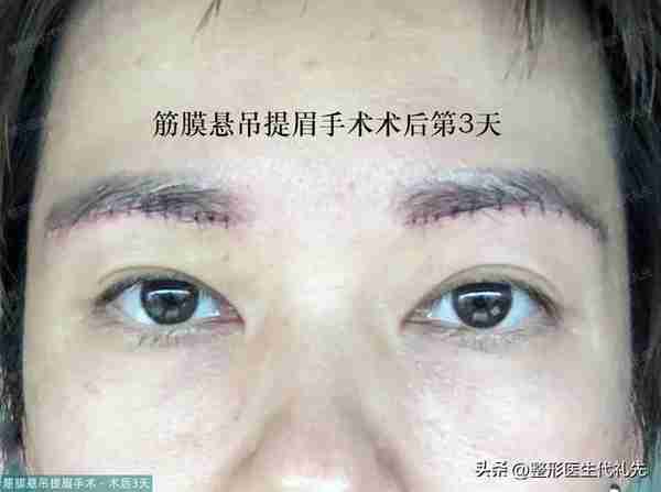 49岁眼皮松弛做提眉还是全切双眼皮?女士选择提眉手术,术后13天