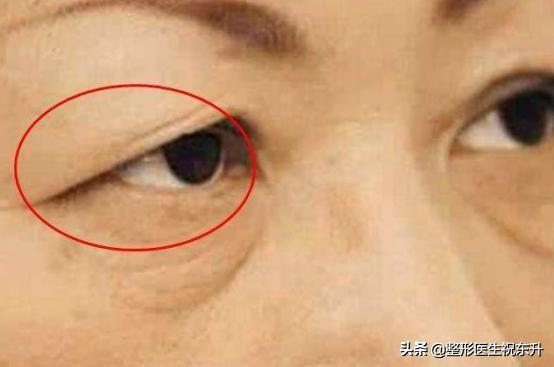 上眼皮松弛,要做手术"去皮、提上去"? 听听医生怎么说