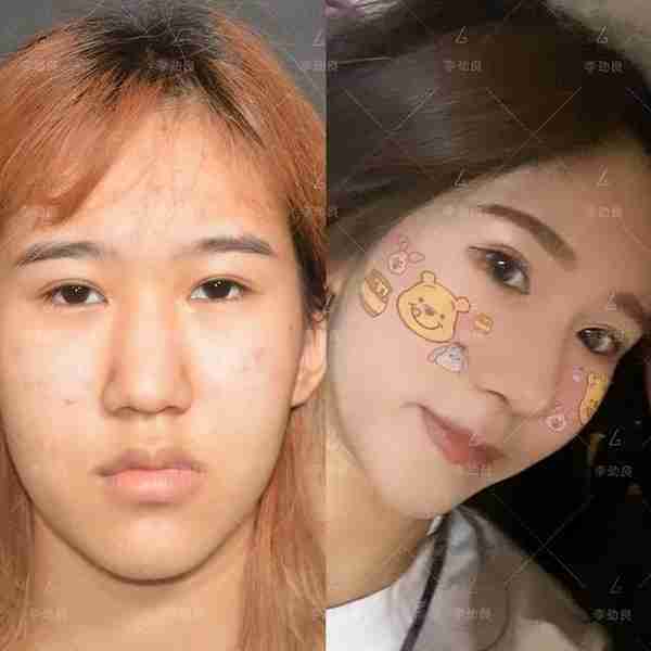 北京20岁女子被叫“大叔”,花6万做鼻子,术后换头,惊艳全家!