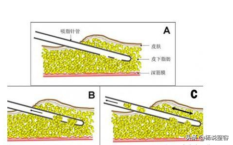 大腿吸脂手术,想要瘦腿的你知道多少?