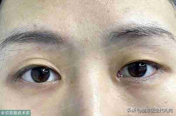 40岁来北京全切开扇形双眼皮,术后半年真实自然,气质180度提升